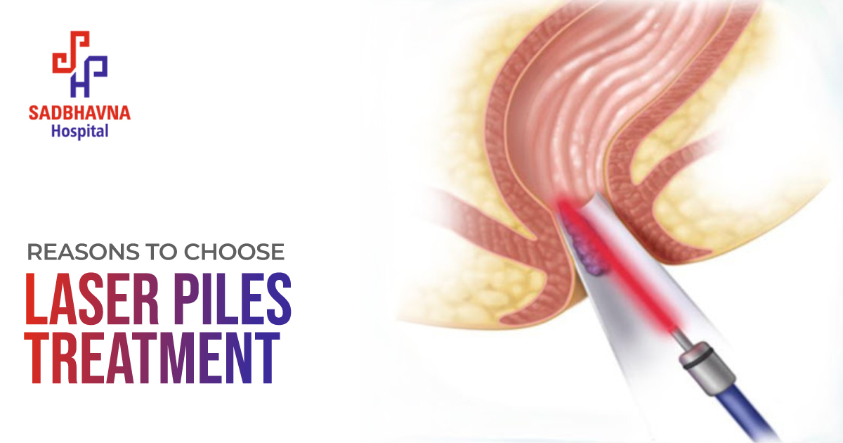 Laser Treatment for Piles