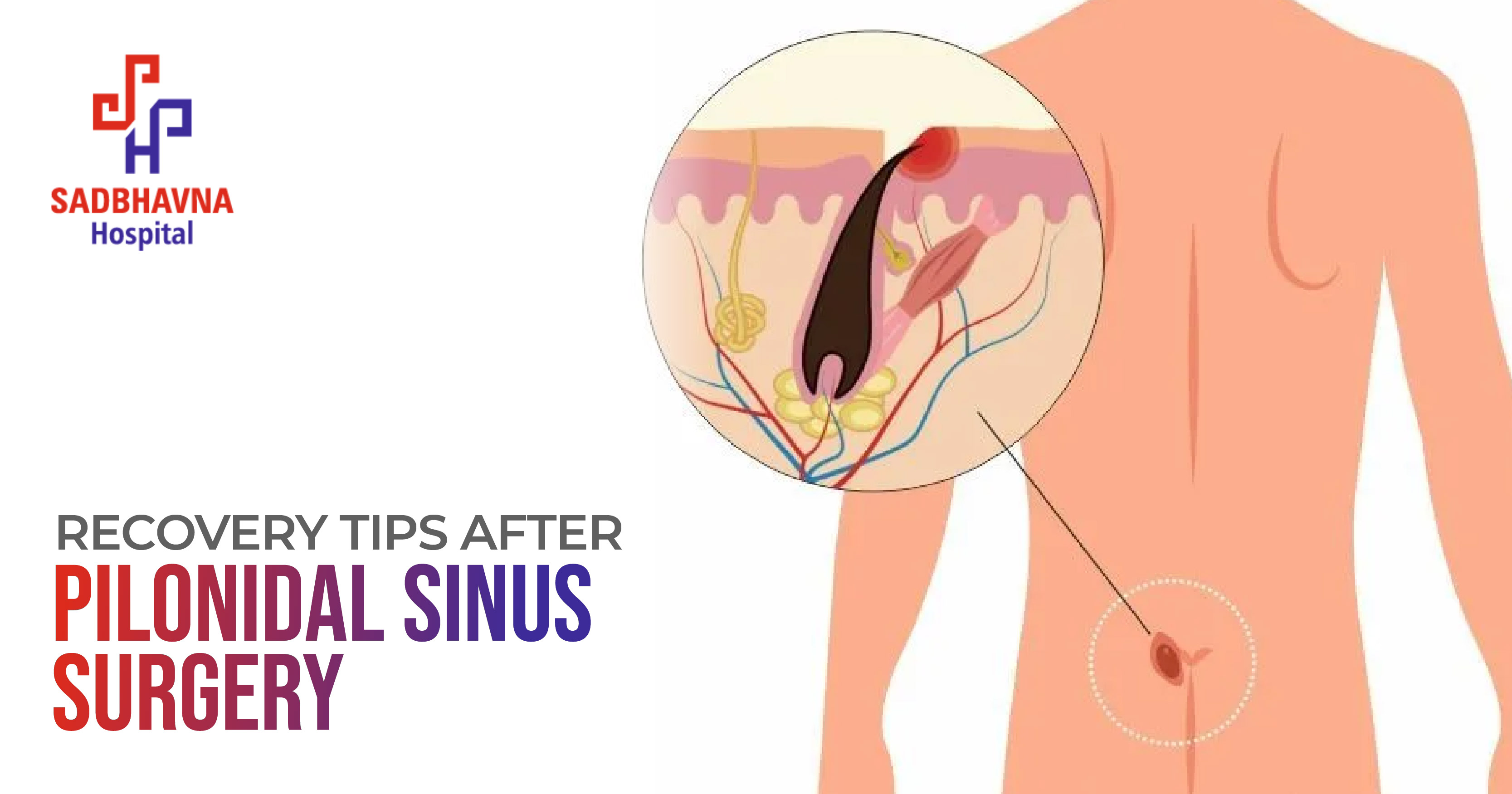 Recovery Tips After Pilonidal Sinus Surgery