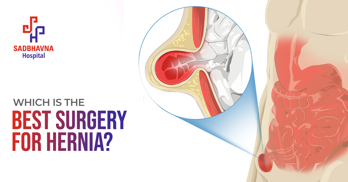 Which is Best Surgery for Hernia?