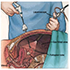 laparoscopy