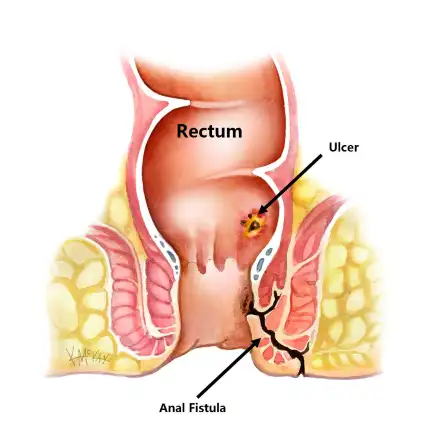 fistula treatment in ahmedabad