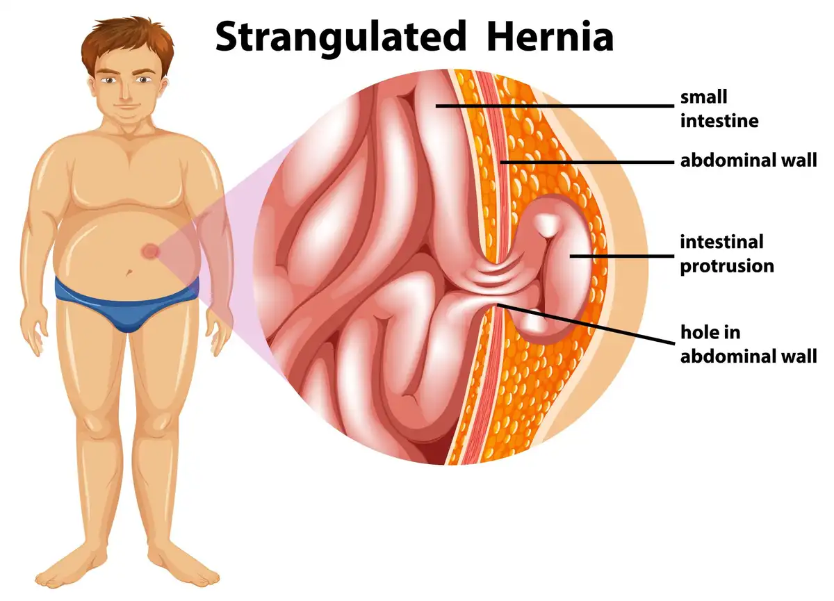hernia treatment in ahmedabad