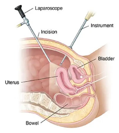 https://www.sadbhavnahospitals.com/assets/img/services/laparoscopic-hysterectomy.webp?utm_source=chatgpt.com