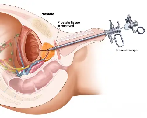 prostate laser surgery in ahmedabad