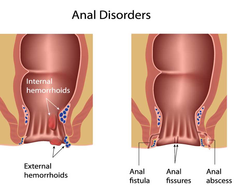 Laser Fistula Surgeon in Ahmedabad