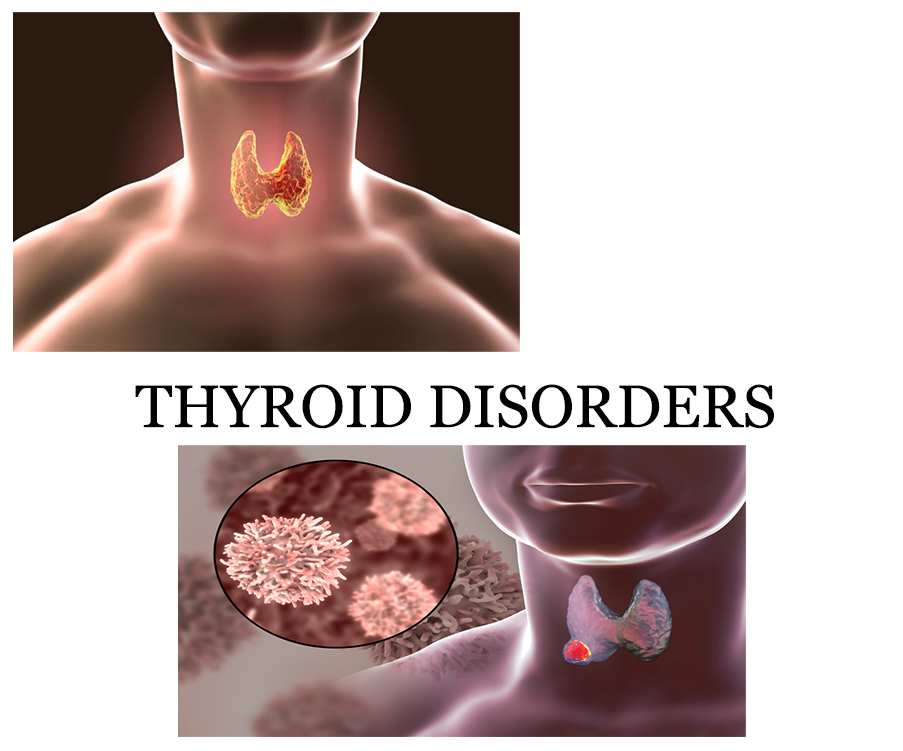 treat thyroid